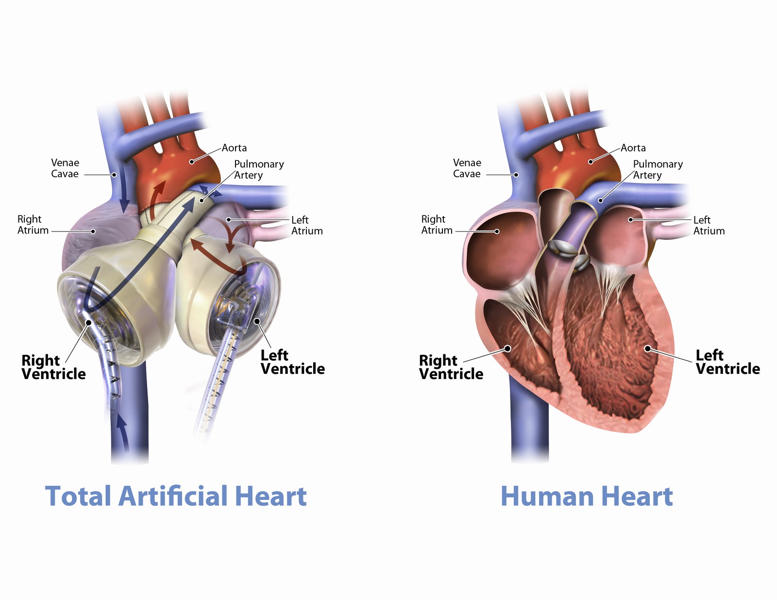 Finland’s First Artificial Heart is Implanted in a Patient – A Rare Treat in the World